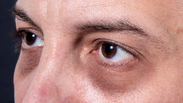 19 Ways To Deal With Dark Circles And Under-Eye Bags