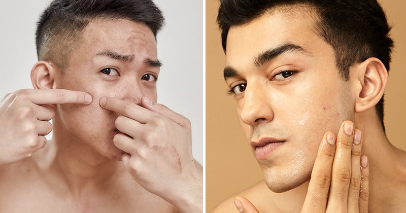 Does Niacinamide Help With Acne Scars? – PrettyBoy