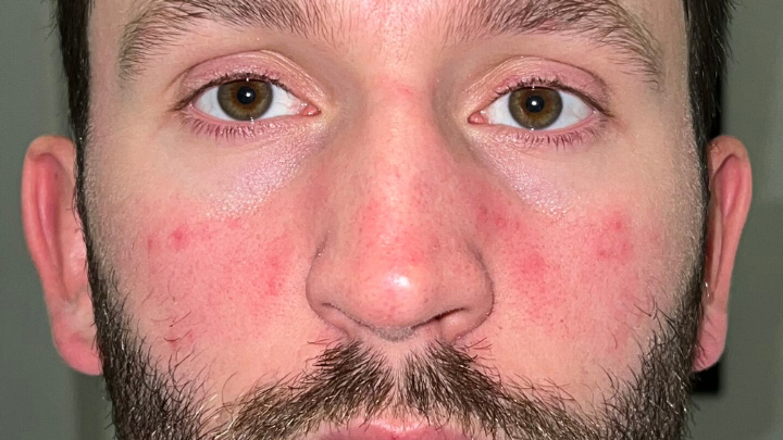 got-a-red-nose-here-are-8-common-causes-and-how-to-treat-them