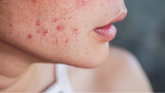 can moisturizer cause acne