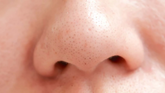 how to get rid of pores on nose